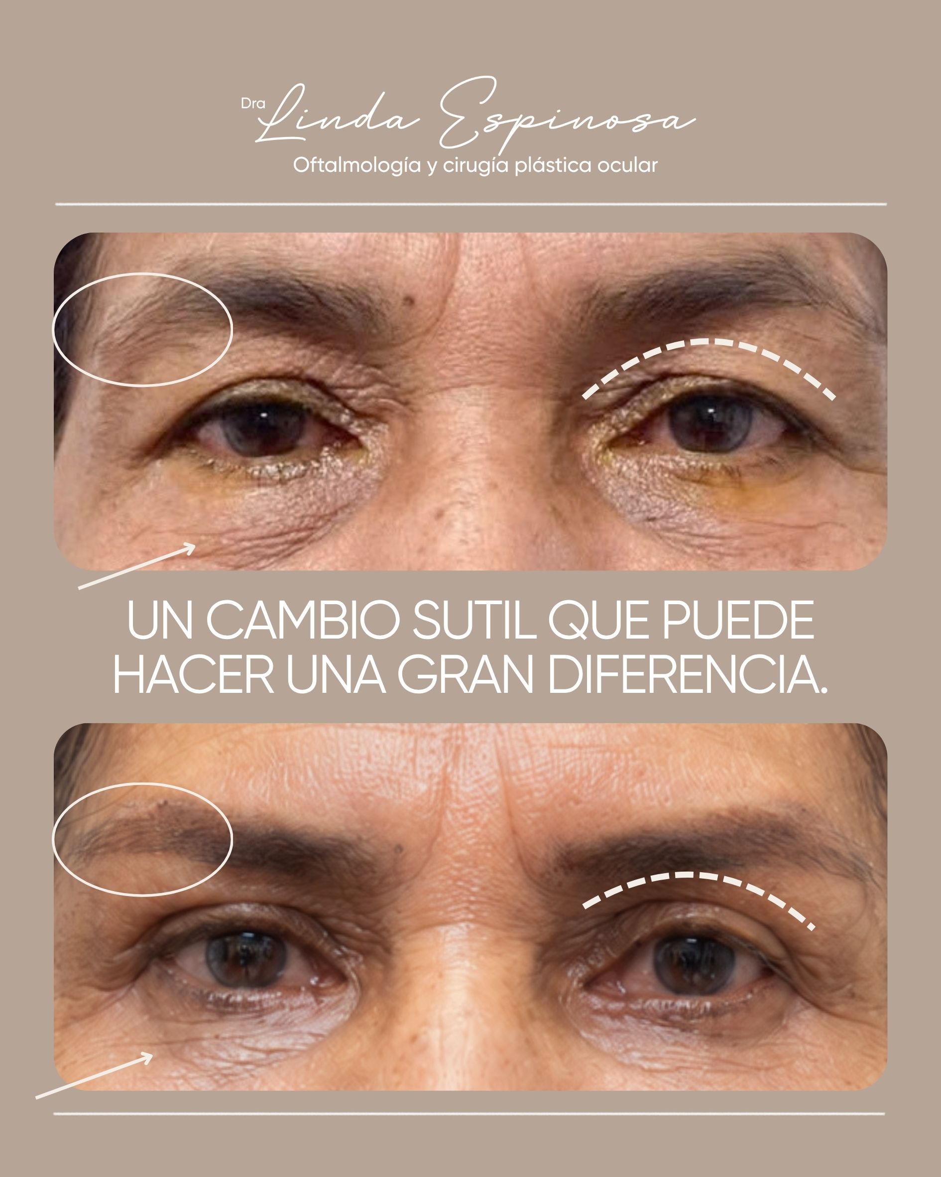 Antes y después de blefaroplastia con la Dra. Linda Espinosa en Medellín, caso 1