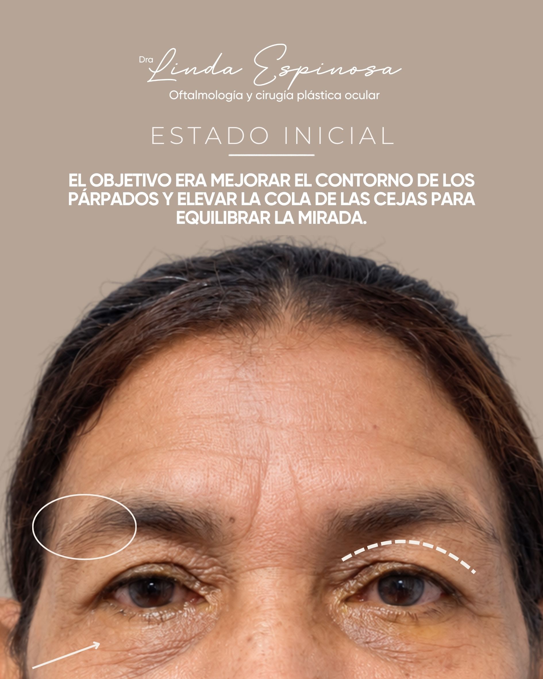 Antes y después de blefaroplastia con la Dra. Linda Espinosa en Medellín, caso 2