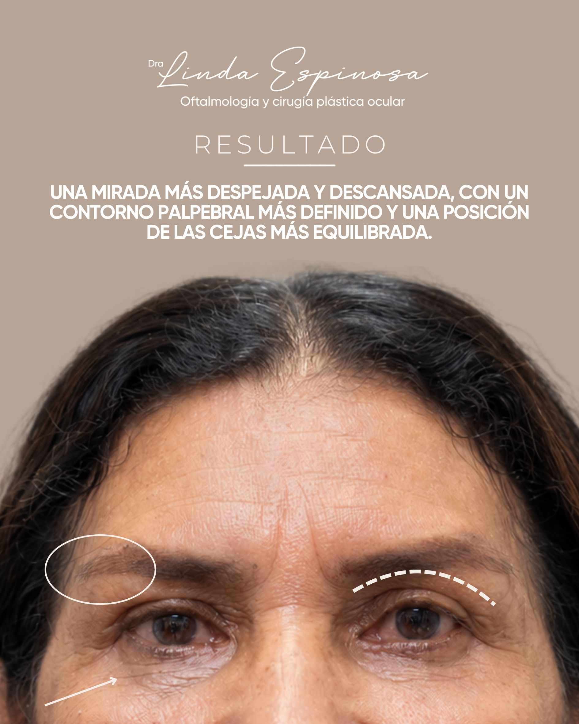 Antes y después de blefaroplastia con la Dra. Linda Espinosa en Medellín, caso 3